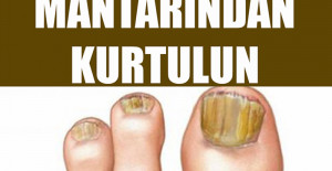 Basit Bir Yöntemle Tırnak Mantarından Kurtulun	