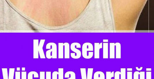 Kanserin Vücuda Verdiği 10 Belirti