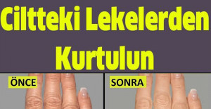 Ünlü Dermatoloji Uzmanın Tarifi İle Ciltteki Lekelerden Kurtulun