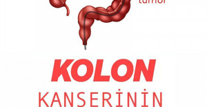 Kolon Kanserinin 5 Belirtisi