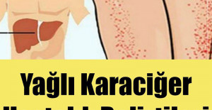 Yağlı Karaciğer Hastalığı Belirtileri