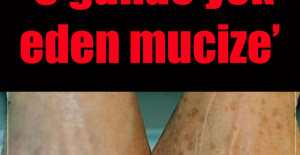 Eldeki lekeleri 3 günde yok eden mucize	