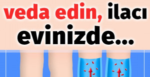 Varisli Damarlardan Kurtulmak İçin Doğal Çözümler