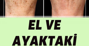 El ve Ayaktaki Lekeleri Silgi Gibi Siliyor