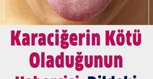 Karaciğerinizin kötü olduğuna işaret eden dildeki beyazlığı bitiren yöntem