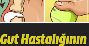 Gut Hastalığının Belirtilerine Dikkat	
