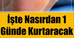 İşte Nasırdan 1 Günde Kurtaracak Doğal Tedavi Yöntemleri