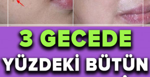 İki Malzemeli Bu Tarif Yüzünüzdeki Lekeleri 3 Gecede Geçiriyor