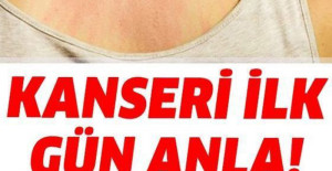 Kanser Olup Olmadığınızın Belirtileri Nelerdir?