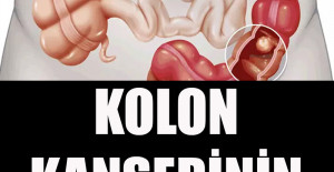 Kolon Kanserinin 5 Belirtisi