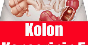 Kolon Kanserinin 5 Belirtisi