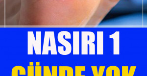 İşte Nasırdan 1 Günde Kurtaracak Doğal Tedavi Yöntemleri