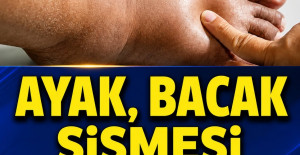 Ayak Bacak Şişmesi Neyin Belirtisi İlk Defa Duyacaksınız