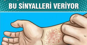 Böbreklerinizin Düzgün Çalışmadığını Gösteren Belirtiler