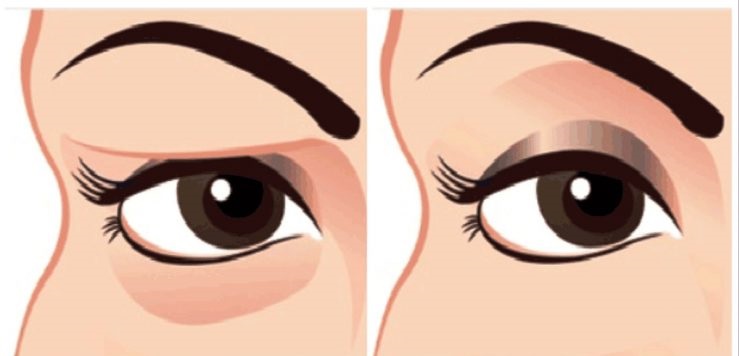 Bu Yöntemi Uygulayanlar Düşük Göz Kapağından Kurtulur - 2