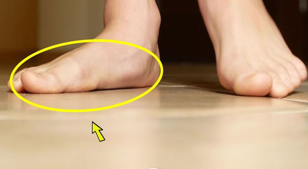 Düz Taban Ayak Nasıl Düzelir? - 6