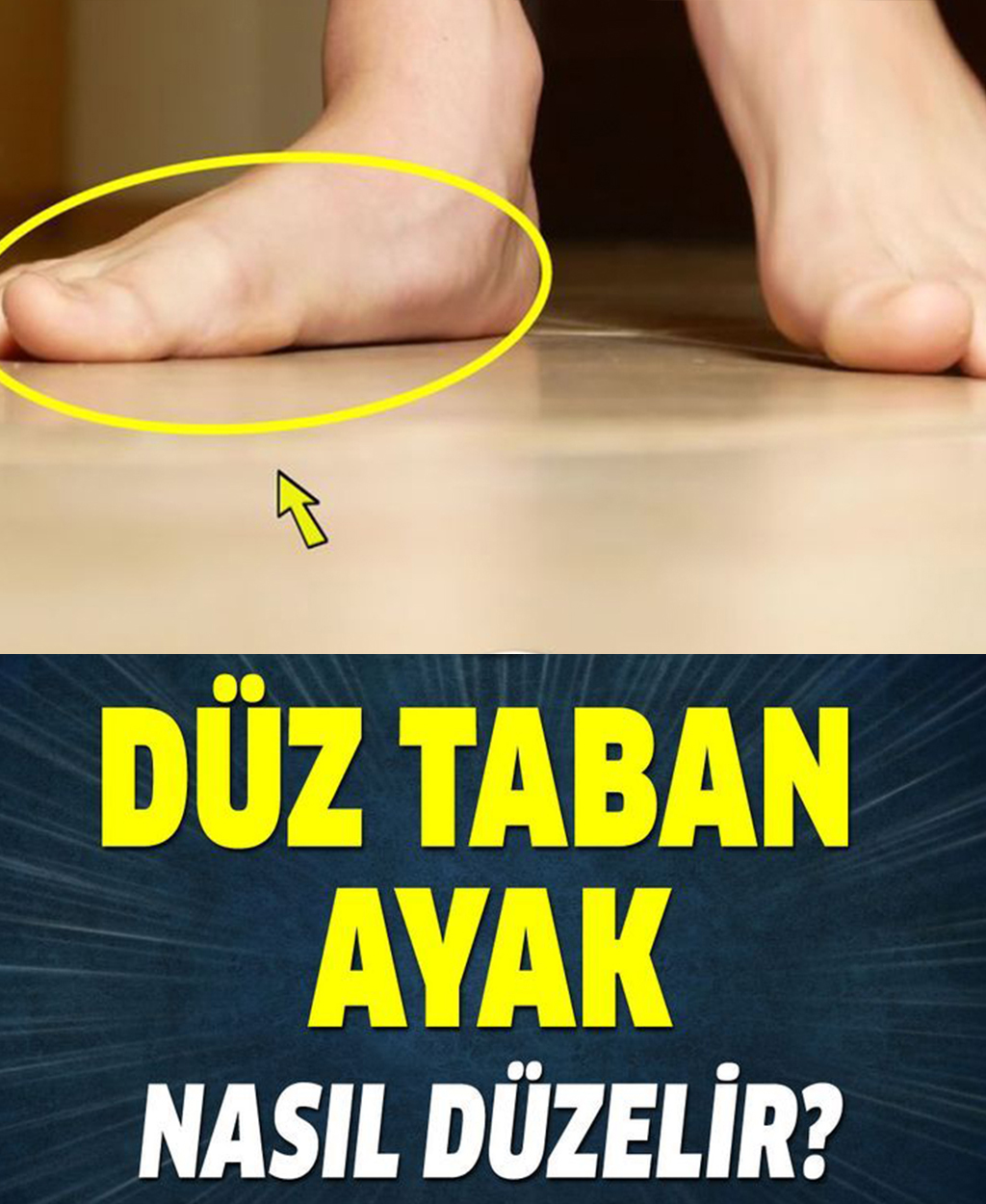 Düz Taban Ayak Nasıl Düzelir? - 1