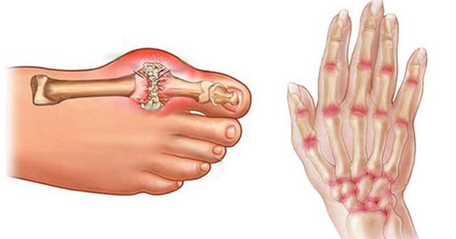 Elleriniz Ve Eklemleriniz Acıyorsa Bunu Bir Kere Yapın Ve Acıya Veda Edin - 5