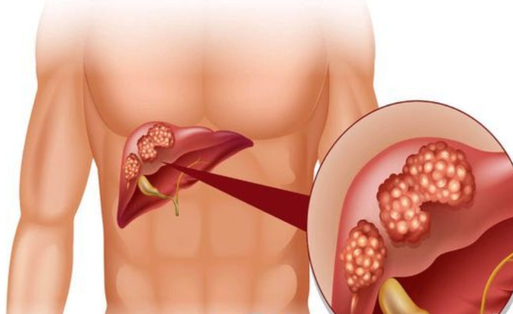 Karaciğer Rahatsızlığını Gösteren Belirtiler Nelerdir? - 4