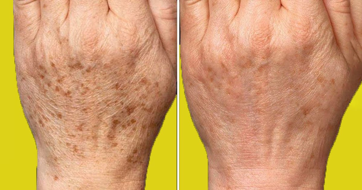 Eldeki Lekeleri Silgi Gibi Siliyor, Ben Deneyince Çok Şaşırdım - 3