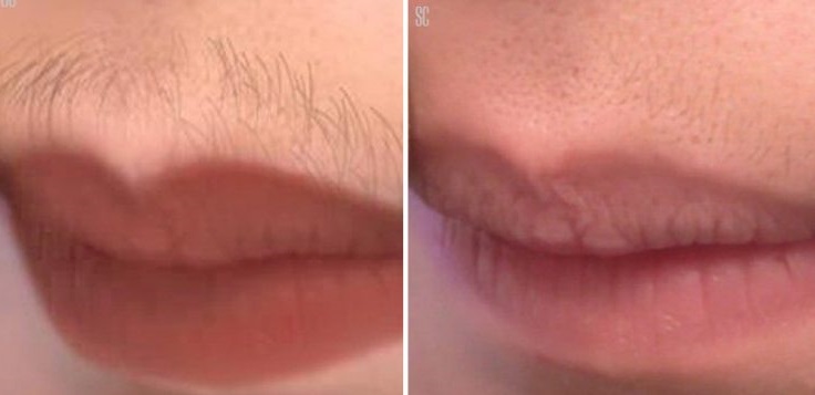 İstenmeyen Tüylerden 15 dakikada Tamamen Kurtulun - 2