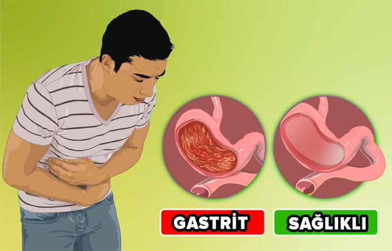Gastrit Olup Olmadığınızı Anlayın - 4