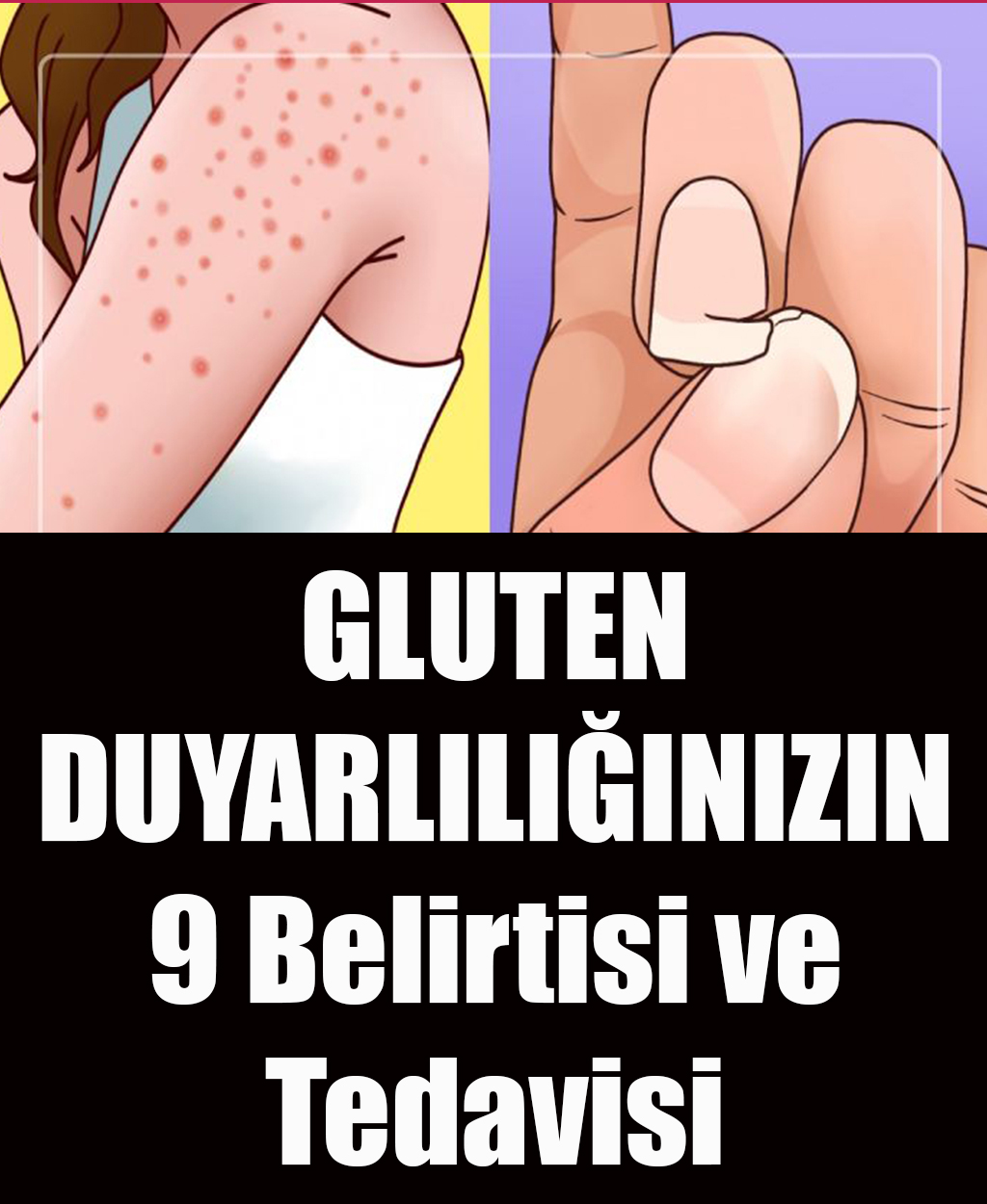 Gluten Hassasiyetinin 9 Belirtisi ve Tedavisi - 1