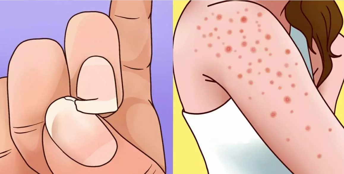 Gluten Duyarlılığınızın Olduğunun 9 Belirtisi - 3