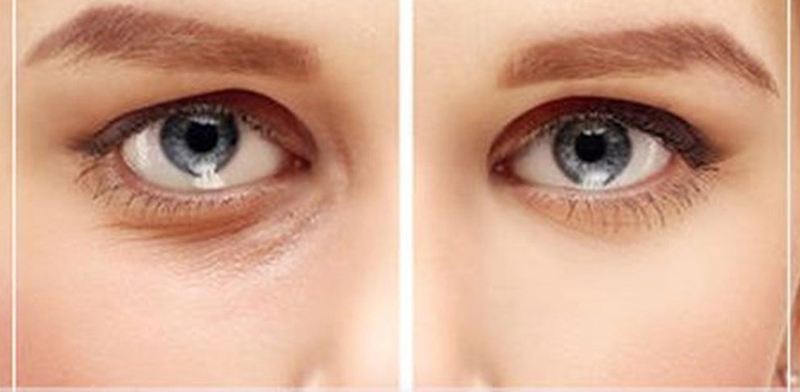 Düşük Göz Kapağını Eski Haline Getirmenin Püf Noktası - 3