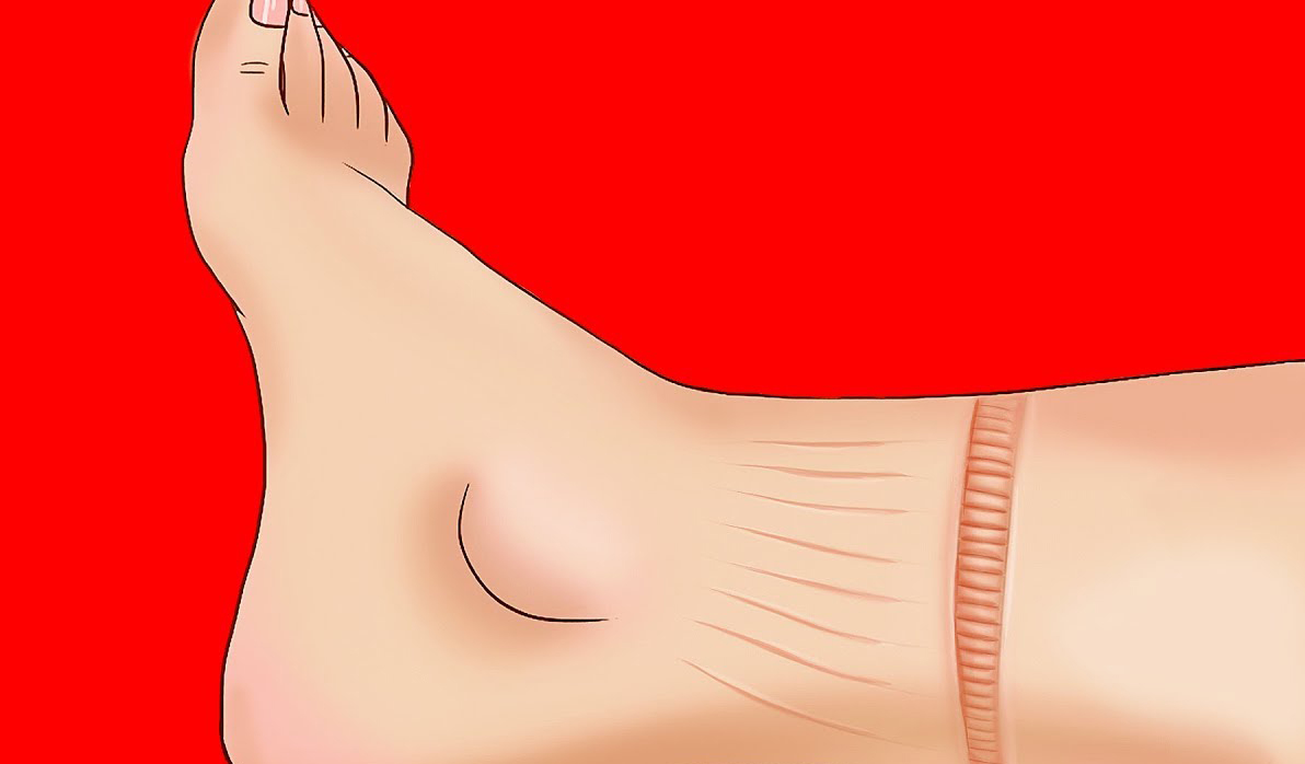 Çorabınız Ayağınızda İz Bırakıyorsa Dikkat - 2