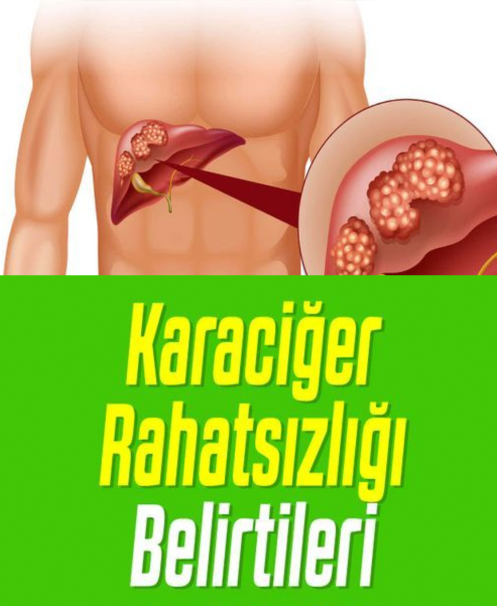 Karaciğer Rahatsızlığını Gösteren Belirtiler Nelerdir? - 1