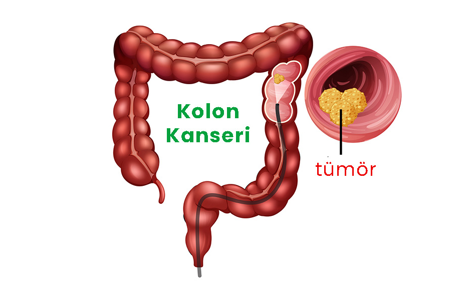 Kolon Kanserinin 5 Belirtisi - 3