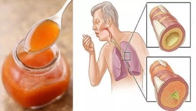 Akciğerlerden Balgam Temizlemede Kullanılan Yöntem - 3