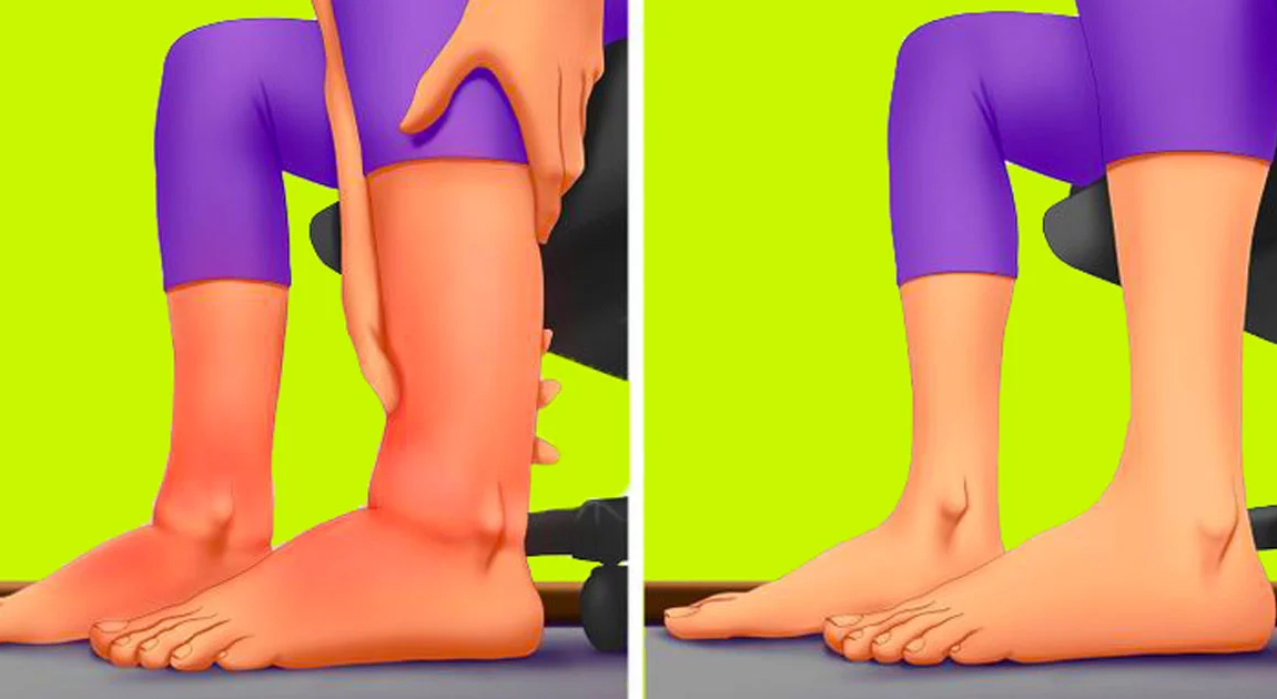 Şişmiş Ayaklar İçin Ne Yapılmalı? - 2