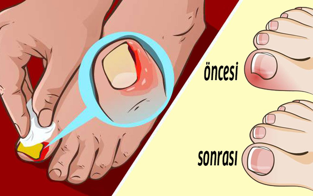 Batık Tırnaklar İçin Gerçekten İşe Yarayan 5 Çözüm - 2