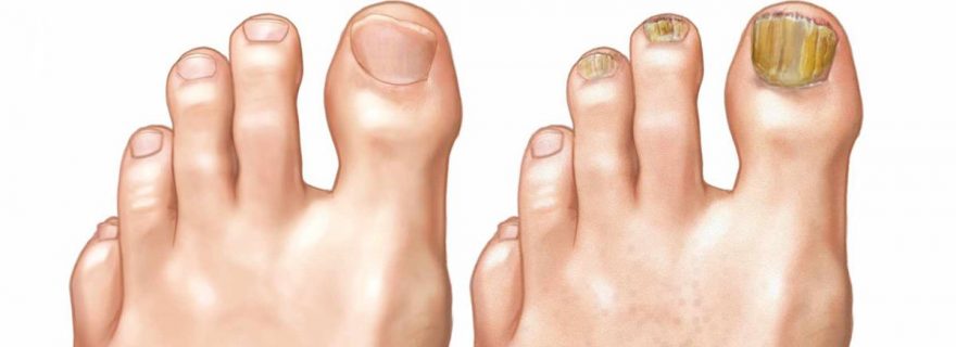 Basit Bir Yöntemle Tırnak Mantarından Kurtulun - 2