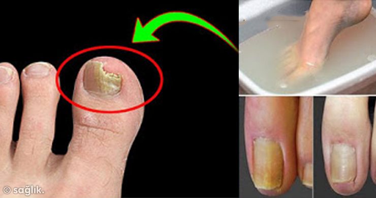 Tırnak Mantarını Temelli Yok Eden Doğal Yöntem - 3