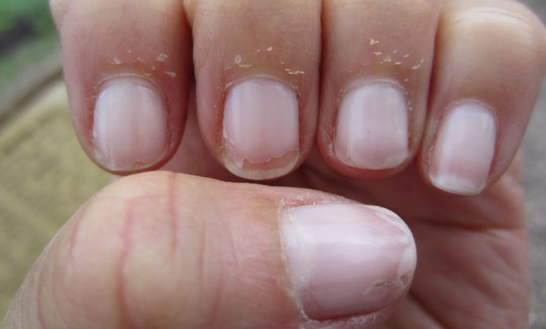 Tırnak Soyulması Hangi Hastalığın Belirtisi - 2
