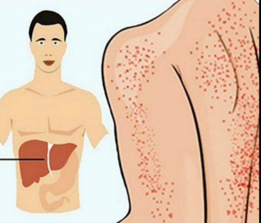 Yağlı Karaciğer Hastalığı Belirtileri - 2