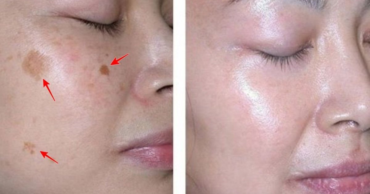 İki Malzemeli Bu Tarif Yüzünüzdeki Lekeleri 3 Gecede Geçiriyor - 4